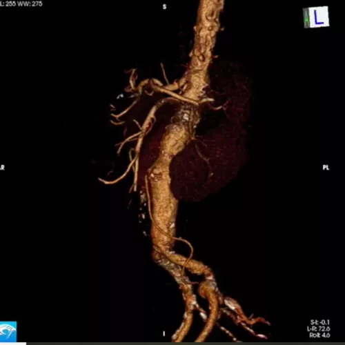 Vida de paciente de 70 anos dependia de solução rápida para aneurisma de aorta abdominal. Foto: Divulgação