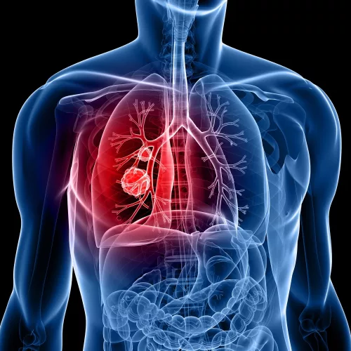Ilustração mostra câncer de pulmão (em vermelho) em uma pessoa. Crédito: iStock